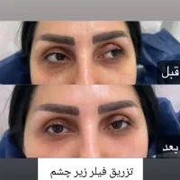 ژل وبوتاکس نخ فیلربادی توسط پزشک|خدمات آرایشگری و زیبایی|تهران, جمهوری|دیوار