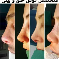 عمل رینوپلاستی و جراحی بینی عمل انحراف بینی|خدمات آرایشگری و زیبایی|اهواز, گلستان|دیوار