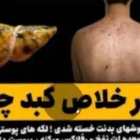 عنوان ش چربی کبد