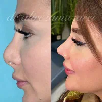 جراحی زیبایی بینی ترمیمی و اولیه