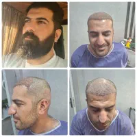 کاشت مو.تخفیف ویژه|خدمات زیبایی و سلامت|شیراز, زرگری|دیوار