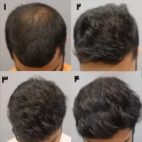 پی آر پی و مزوتراپی مو و ابرو