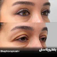 لیزیک چشم /لیپوماتیک /آبدومینو/ کاشت مو/بلفارو|خدمات آرایشگری و زیبایی|کرمانشاه, |دیوار