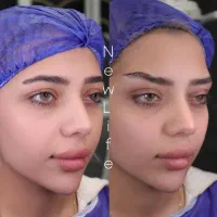 جراحی دایرکت ابرو