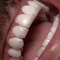 جشنواره پاییزه کامپوزیت،لمینیت،ایمپلنت اقساط|خدمات آرایشگری و زیبایی|بومهن, |دیوار