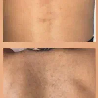 فیشال تخصصی صورت وایتنینگ بدن در کلینیک زیرنظرپزشک|خدمات آرایشگری و زیبایی|اسلامشهر, باغ فیض|دیوار