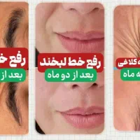 بوتاکس خانگی