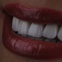 دندانپزشکی تخصصی ،کامپوزیت ،لمینیت، عصبکشی