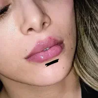 تزریق ژل و بوتاکس، پرسینگ و آنزیم