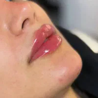 مدل بوتاکس و فیلر لب چونه گونه فول فیس