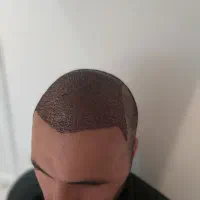 کاشت موی تخصصی با پرداخت اقساطی