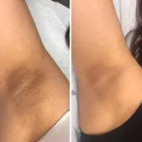 جشنواره لیزر فول بادی فقط 490 آف زمستانی