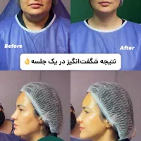 نیاز فوری به مانکن جهت تزریق بوتاکس و فیلر لب|خدمات آرایشگری و زیبایی|تهران, امانیه|دیوار