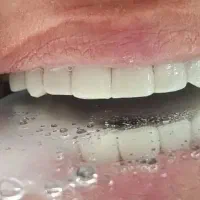 دندانپزشکی کامپوزیت ونیر فقط 9میلیون  اقساطی|خدمات آرایشگری و زیبایی|ارومیه, |دیوار