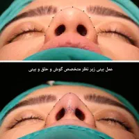 ابدومینوپلاستی.لیپو360.ماموپلاستی .پروتزسینه.بینی|خدمات آرایشگری و زیبایی|تهران, جماران (نیاوران)|دیوار