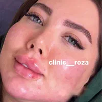 مدل تزریق ژل و بوتاکس کانتورینگ عربی ،لب روسی|خدمات آرایشگری و زیبایی|کرج, گوهردشت|دیوار