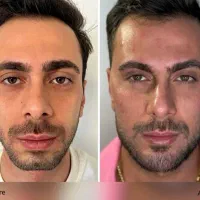 فیلر زل بوتاکس مزو بایو فیس لیفت پر کننده50/|خدمات آرایشگری و زیبایی|مشهد, هفت تیر (حافظ)|دیوار