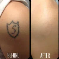 پاک کردن تتو و خالکوبی با دستگاه لیزر