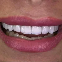 خدمات زیبایی کامپوزیت لمینیت بلیچینگ