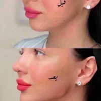 فیلر ژل بوتاکس زیرچشم فیلر بینی زاویه در مطب پزشک