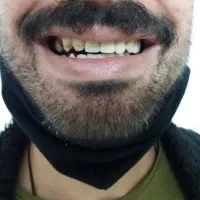 ساخت و تعمیر انواع پروتز های متحرک (دندان مصنوعی)|خدمات آرایشگری و زیبایی|دوگنبدان, |دیوار