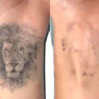 جشنواره لیزر و رفع لک و تتو کلینیک زیبایی