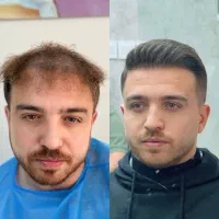 کاشت مو و ابرو.با شرایط ویژه پنچ تومن|خدمات آرایشگری و زیبایی|تبریز, |دیوار