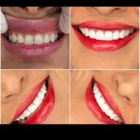 برطرف کردن تمام عیوب دندان|آرایشی، بهداشتی، درمانی|سیرجان, |دیوار