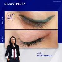 ریموو تخصصی تتوی قدیمی