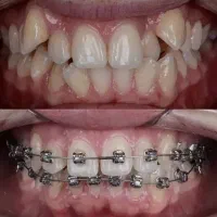 ارتودنسی توسط متخصص*اقساط بدون چک و کارمزد*