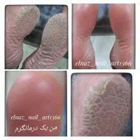 رفع ترک و تیرگی پا کفسابی پدیکور ۳۵۰ در یک جلسه