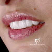 لمینیت دندان به سبک بلاگر