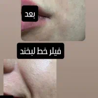 ساکشن چربی و تزریق ژل و بوتاکس و مزو لیفت شقیقه و.|خدمات آرایشگری و زیبایی|کرمانشاه, |دیوار