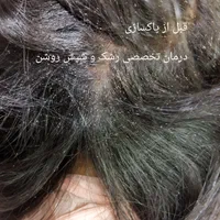 درمان سریع و گیاهی رشک و شپش بدون مواد شیمیایی|خدمات آرایشگری و زیبایی|یزد, |دیوار