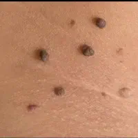 hpv/hsv|آرایشی، بهداشتی، درمانی|بندر ماهشهر, |دیوار