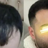 ۵۰٪تخفیف کاشتمو در شیراز