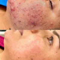 هایفوتراپی و فشیال پوست کره ای