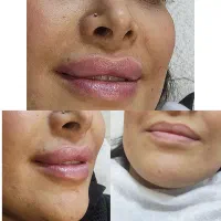 خدمات ژل وبوتاکس(خانمهاوآقایون)