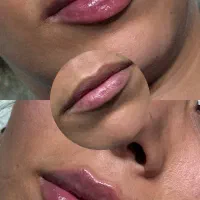 تزریق ژل و بوتاکس.مزو. خالبرداری توسط پزشک