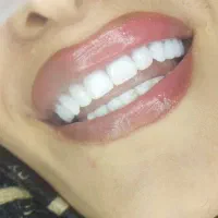 دندانسازی یک روزه و از دم قسط (محلات در قزوین)