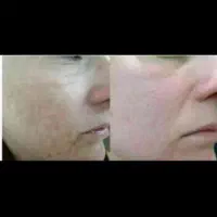 اگزوزوم تراپی و پی ار پی|خدمات آرایشگری و زیبایی|شیراز, قدوسی شرقی|دیوار