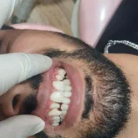 کامپوزیت دندان ۸۰۰تومان
