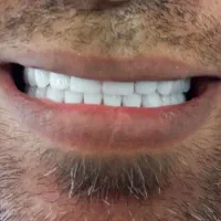 دندان مصنوعی اقساط ، دندانسازی دم قسط