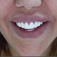 زیبایی،کامپوزیت دندان،عصب کشی(یاسوج)|خدمات آرایشگری و زیبایی|دوگنبدان, |دیوار