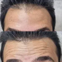 جشنواره تزریق بوتاکس با تخفیف ویژه توسط پزشک