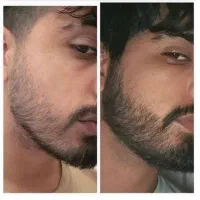 اگه از ریزش و کم پشتی خسته شدی کلیک کن
