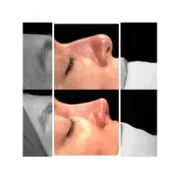 جراحی بینی با بیمه+تخفیف ویژه زمستانه