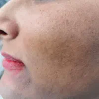 فیشیال تخصصی ، پاکسازی پوست|خدمات آرایشگری و زیبایی|مشهد, شهرک لشکر (شهرک غرب)|دیوار