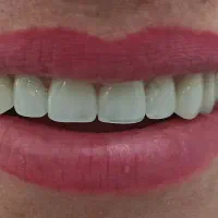 دندانسازی آوا قرارداد مستقیم کلیه بیمه ها|خدمات آرایشگری و زیبایی|خرم‌آباد, |دیوار