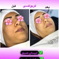 تخفیف فیشیال کلاسیک(رفع جوش سرسیاه)|خدمات آرایشگری و زیبایی|دوگنبدان, |دیوار